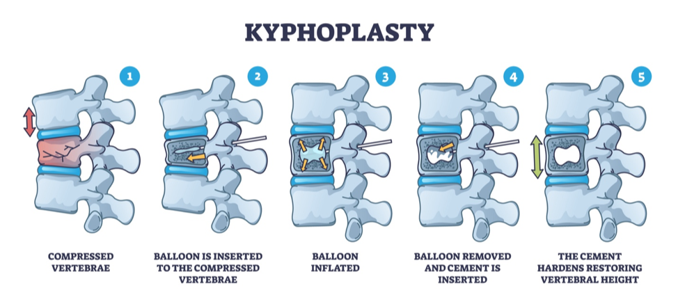 Kyphoplasty Steps